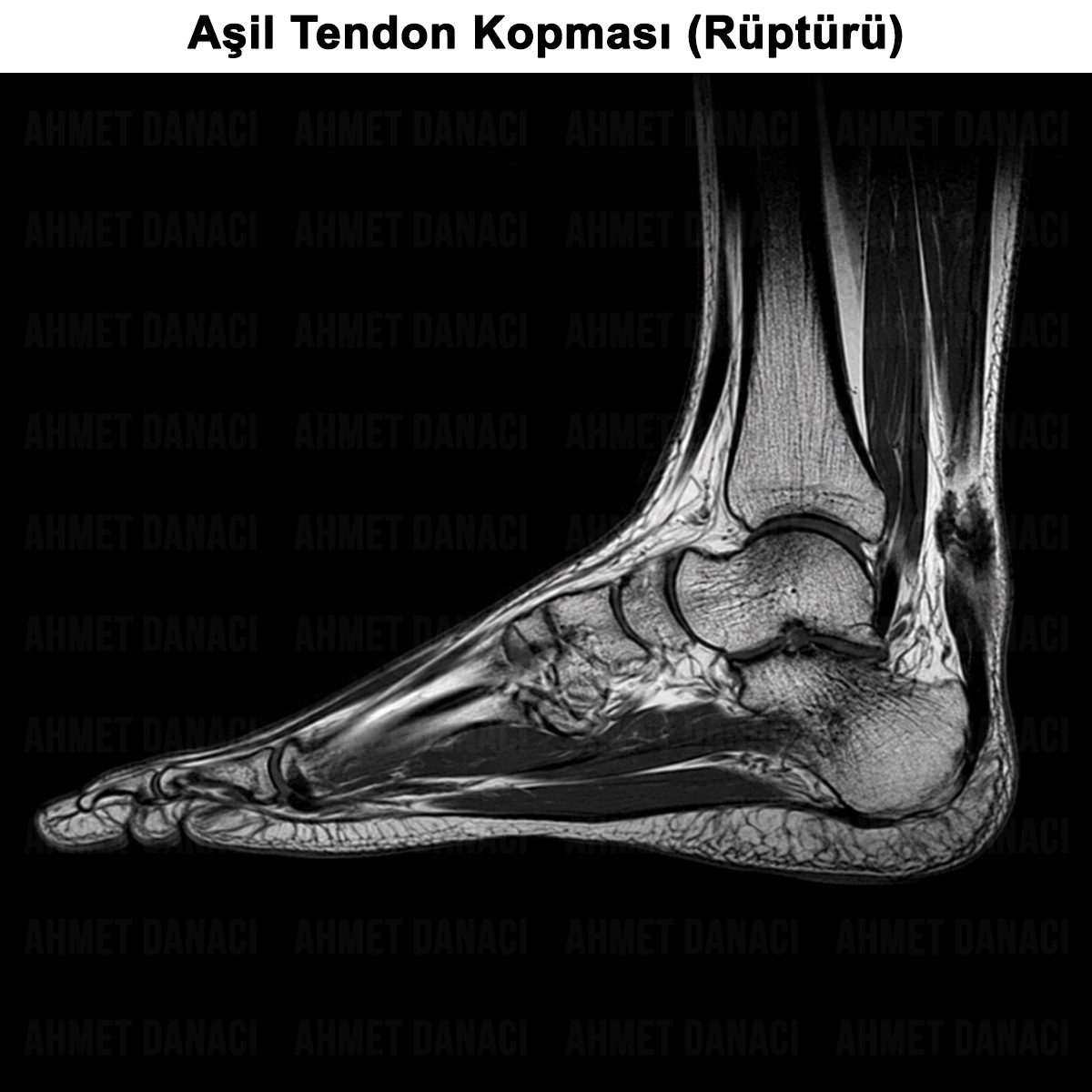Aşil Tendon Kopması (Rüptürü): Nedir? Nasıl Anlaşılır?