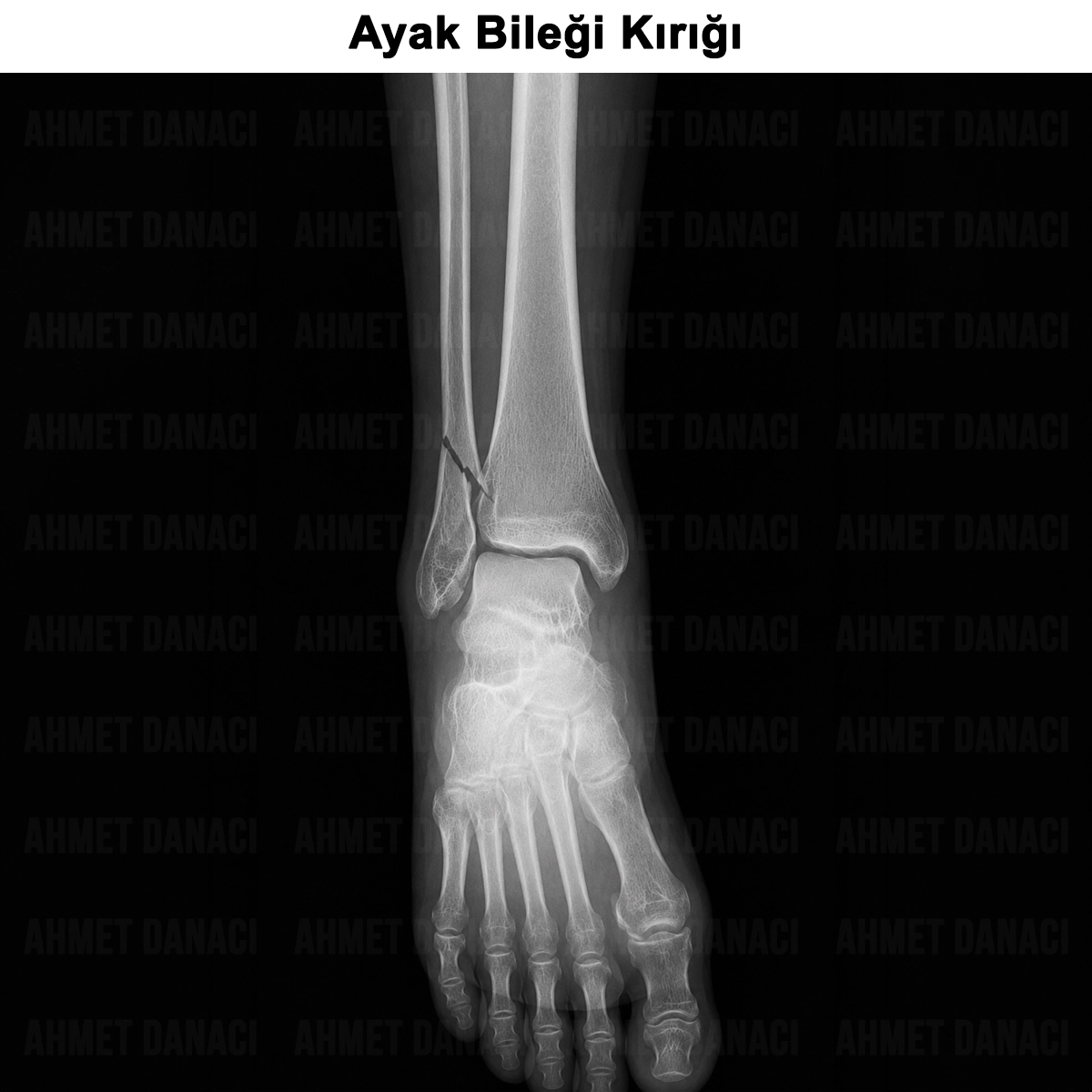 Ayak Bileği Kırığı: Nasıl Oluşur? Tedavisi? Ameliyatı?