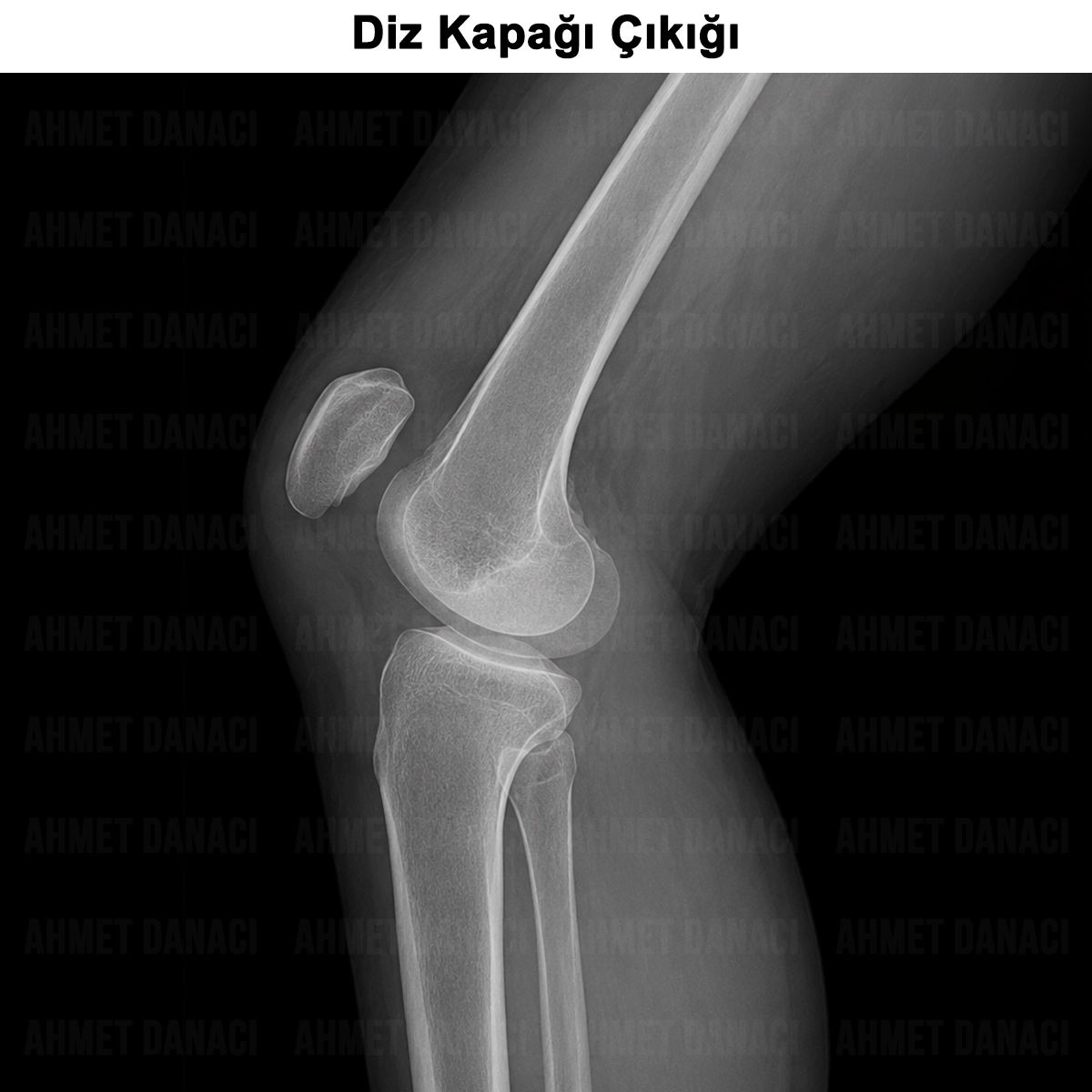 Diz Kapağı Çıkığı: Nedenleri, Teşhisi, Ameliyatsız Tedavisi