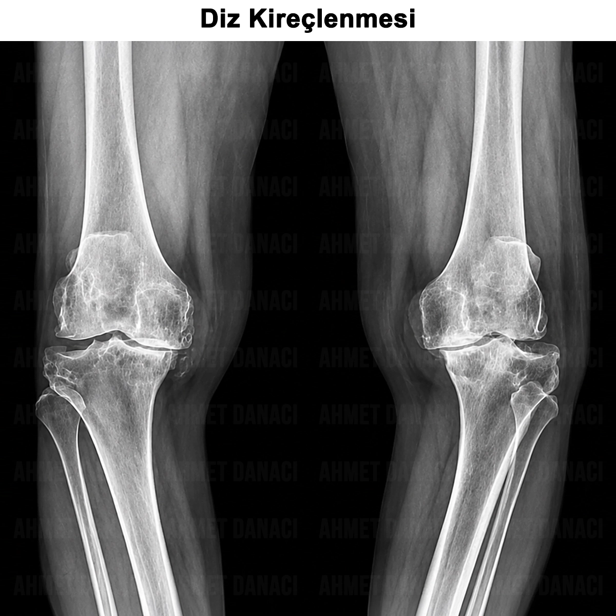Diz Kireçlenmesi (Gonartroz): Nedir? Neden Olur? Tedavisi?
