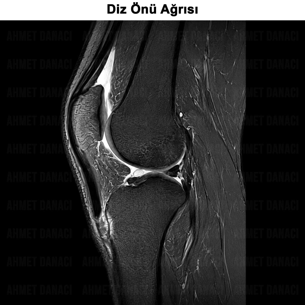 Diz Önü Ağrısı: Nedir? Neden Olur? Tedavisi?