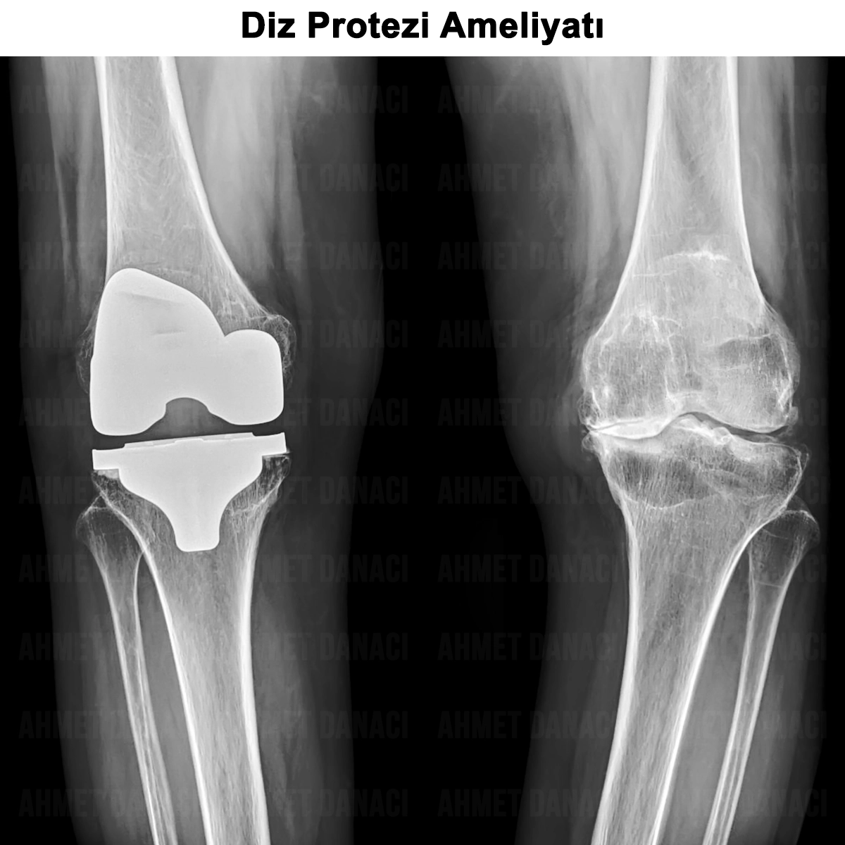 Diz Protezi Ameliyatı: Nedir? Kimlere Uygulanır? Riskli Mi?