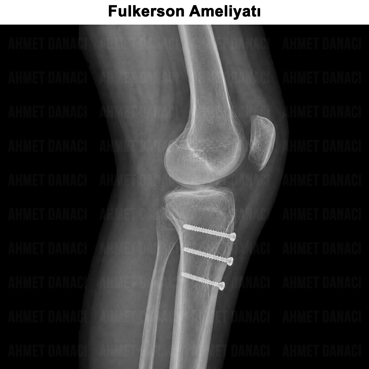 Fulkerson Ameliyatı: Nedir? Kimlere Yapılır? Nasıl Yapılır?
