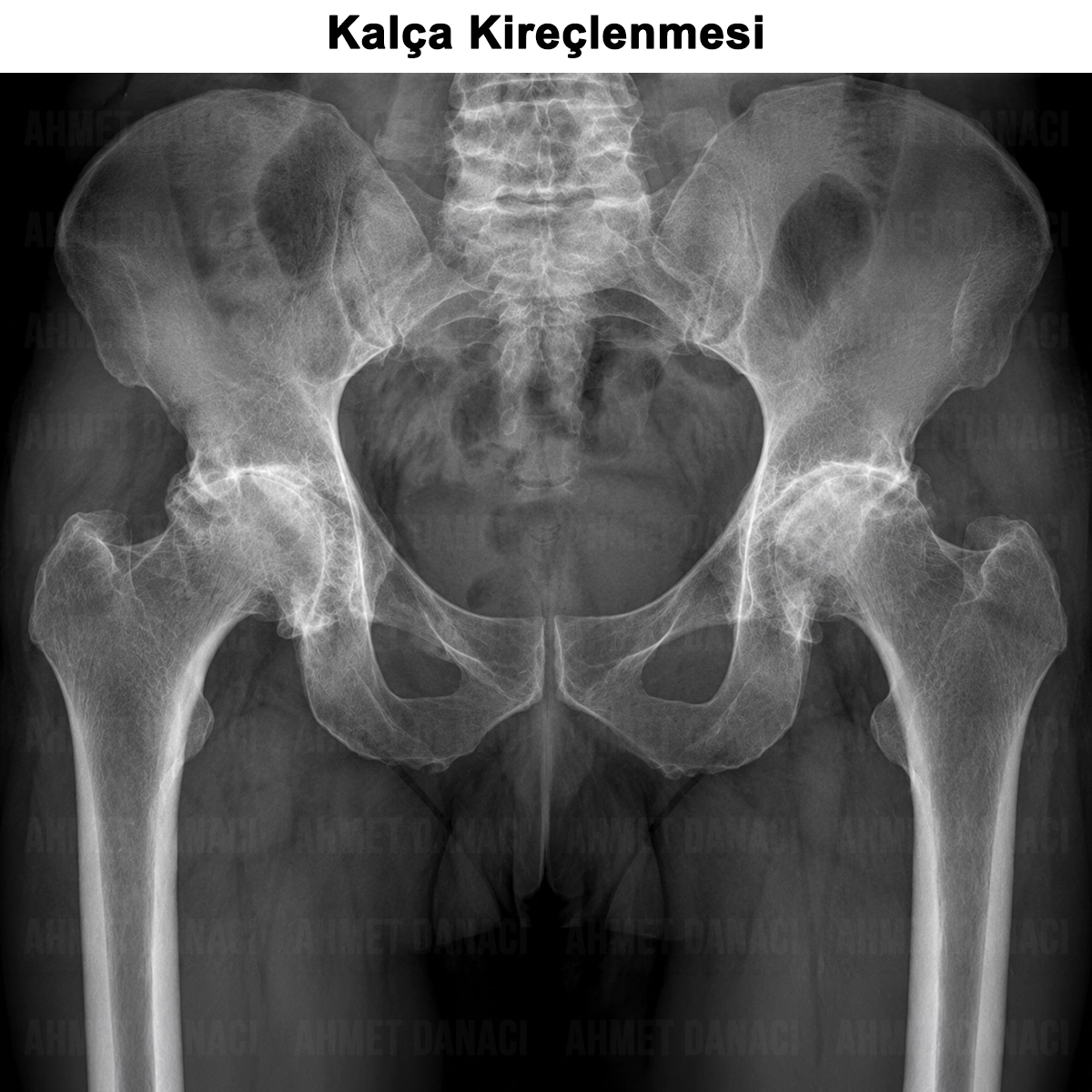 Kalça Kireçlenmesi (Koksartroz): Nedir? Tanısı ve Tedavisi