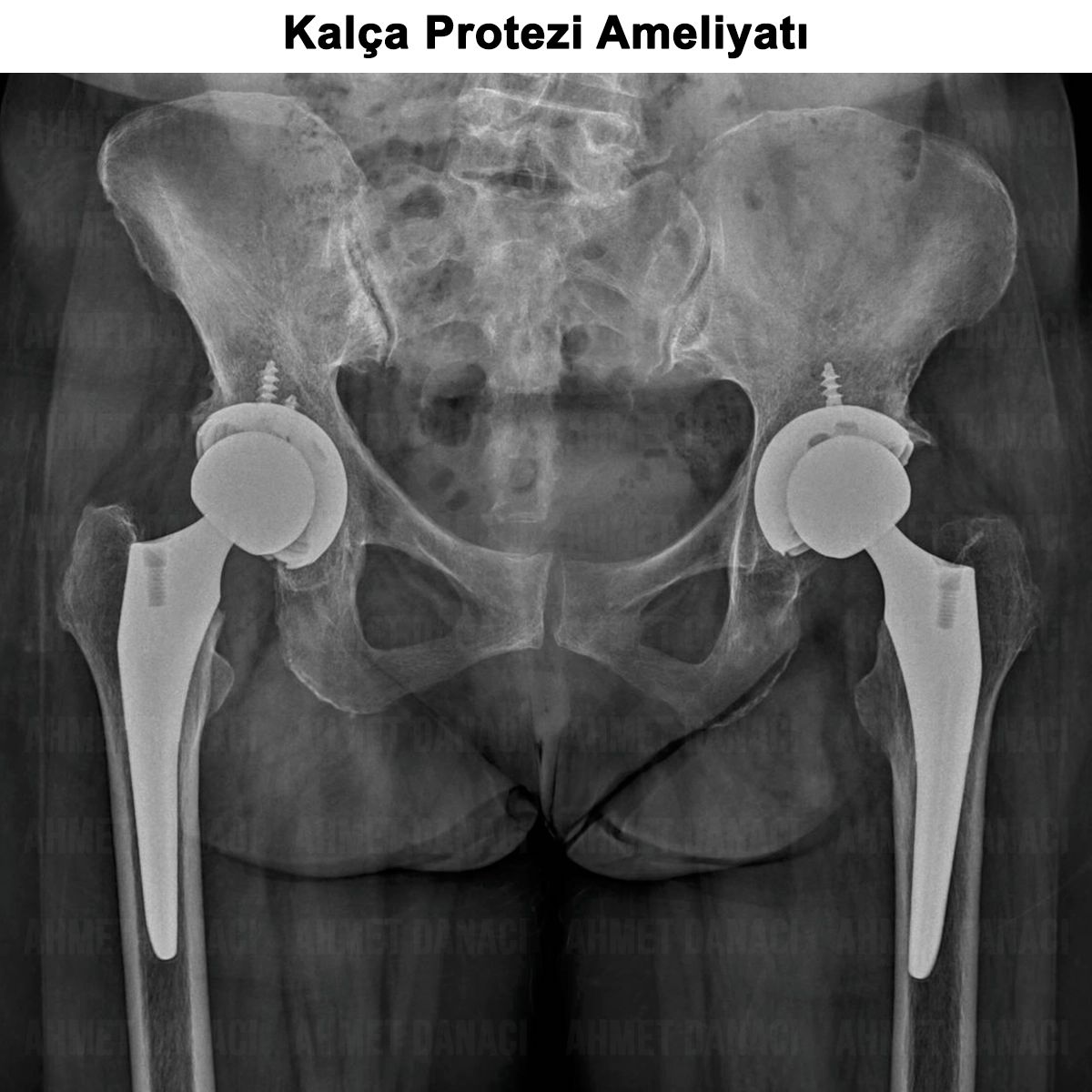 Kalça Protezi Ameliyatı: Kimlere ve Nasıl Yapılır? Riskleri?