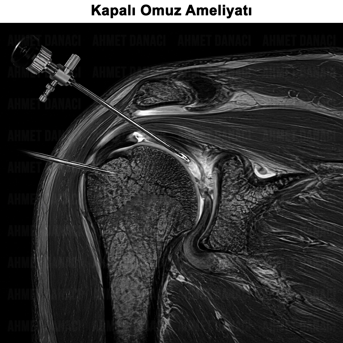 Kapalı Omuz Ameliyatı: Omuz Artroskopisi Nedir? Avantajları?