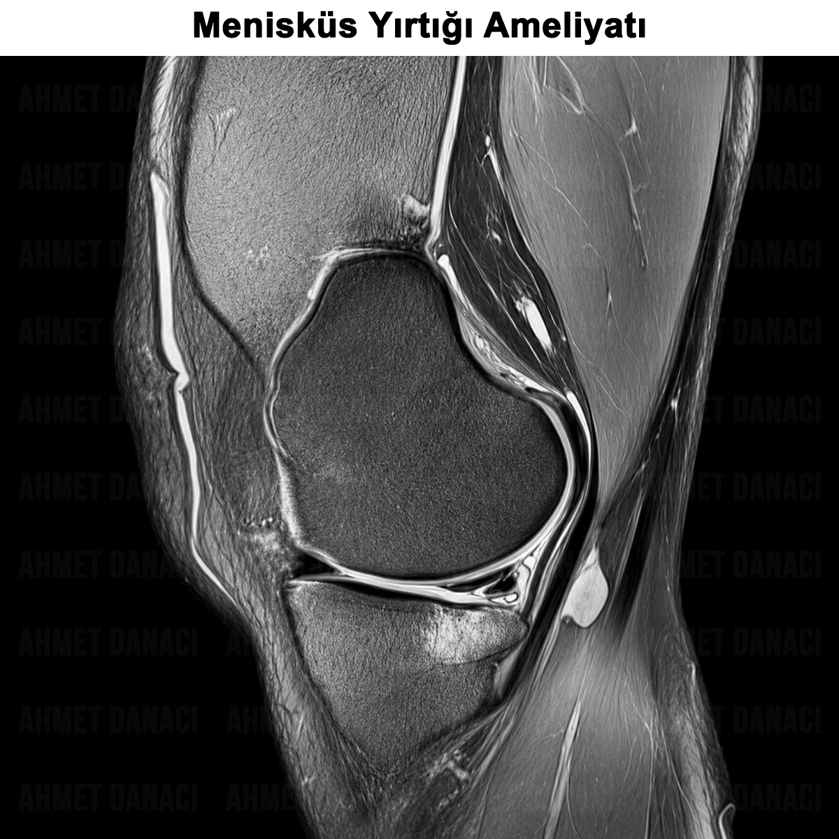 Menisküs Ameliyatı: Nedir? Nasıl Yapılır? Kimlere Yapılır?