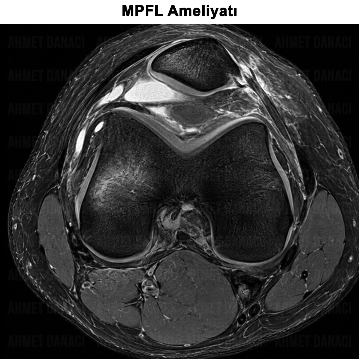 MPFL Ameliyatı: Nedir? Kimlere Yapılır? İyileşme Süreci?