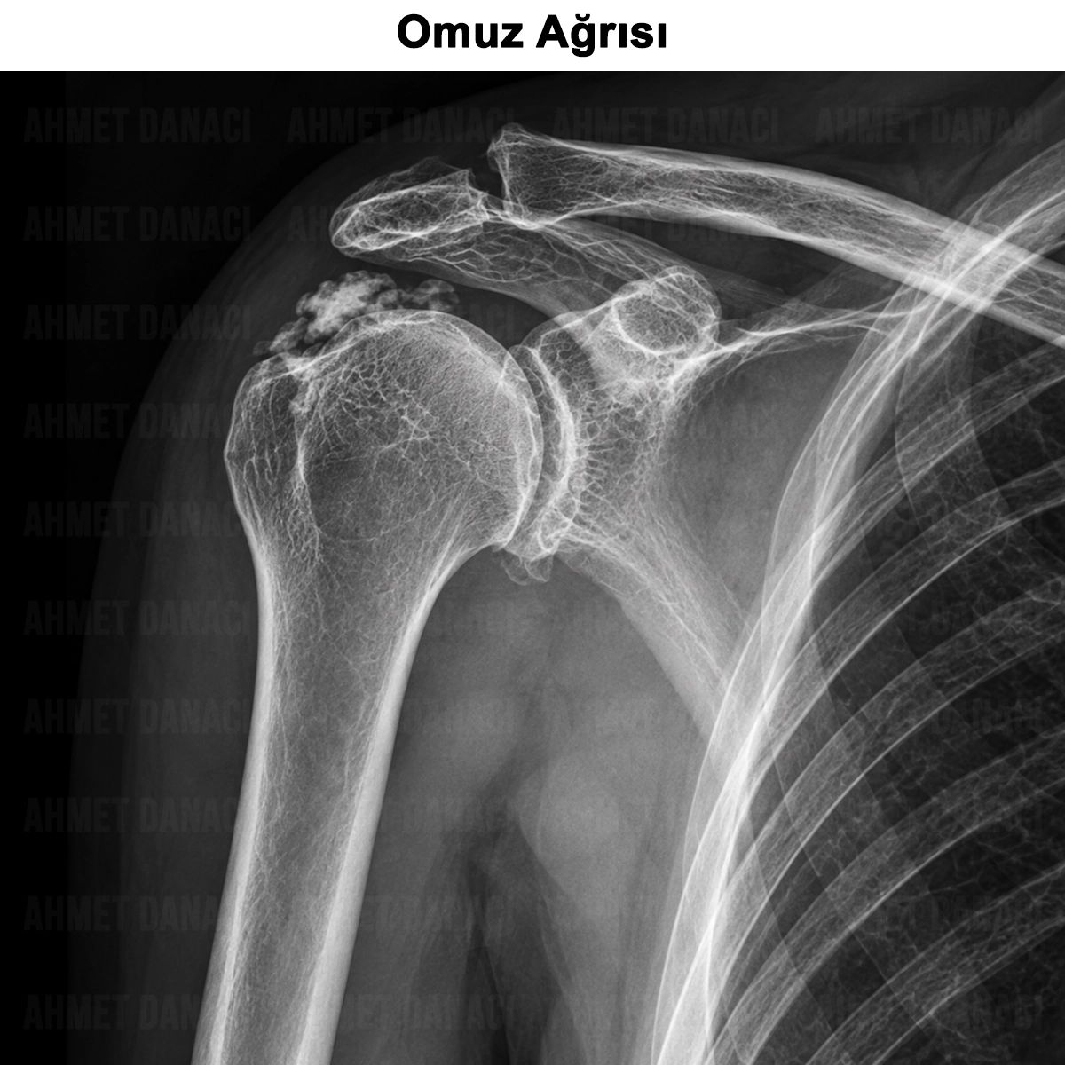 Omuz Ağrısı: Nedenleri, Tanısı ve Tedavisi