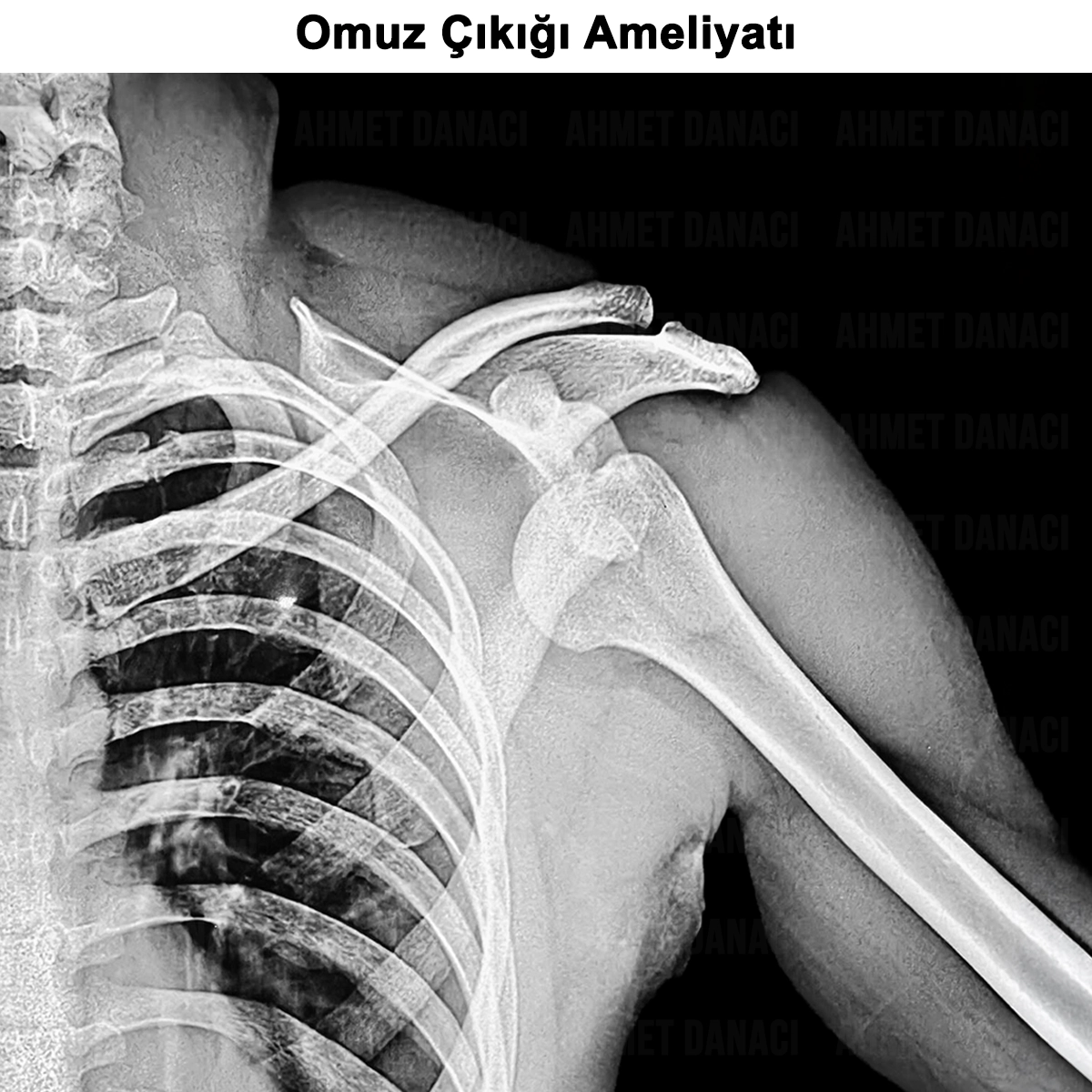Omuz Çıkığı Ameliyatı: Kimlere Yapılır? Nasıl Yapılır?