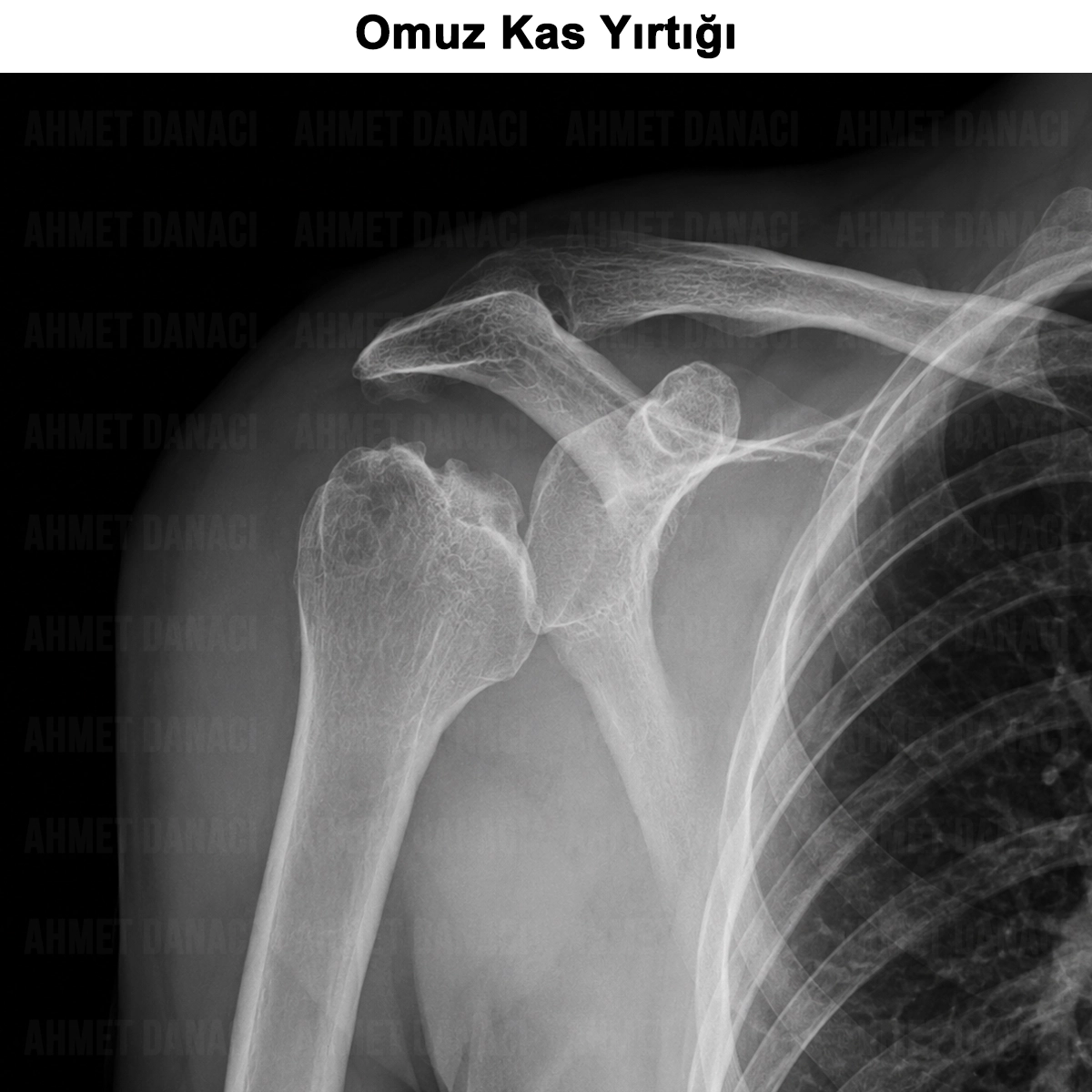 Omuz Kas Yırtığı: Neden Olur? Nasıl Önlenir? Tedavisi?