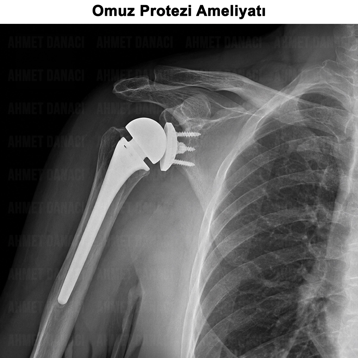 Omuz Protezi Ameliyatı: Nedir? Kimlere ve Nasıl Yapılır?