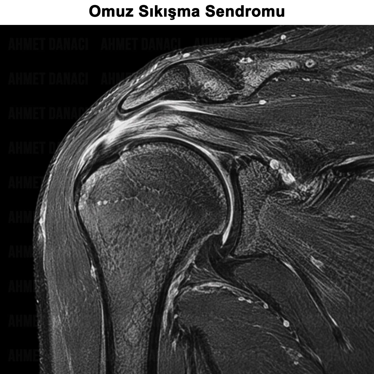 Omuz Sıkışma Sendromu: Nedir? Nedenleri? Tanısı ve Tedavisi