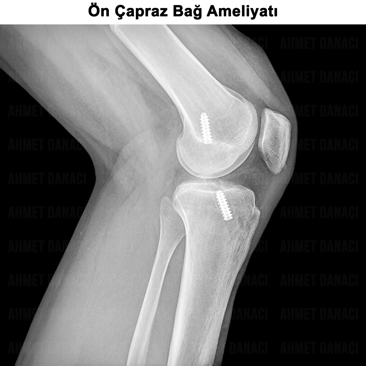 Ön Çapraz Bağ Ameliyatı: Nedir? Nasıl Yapılır? Sonrası?