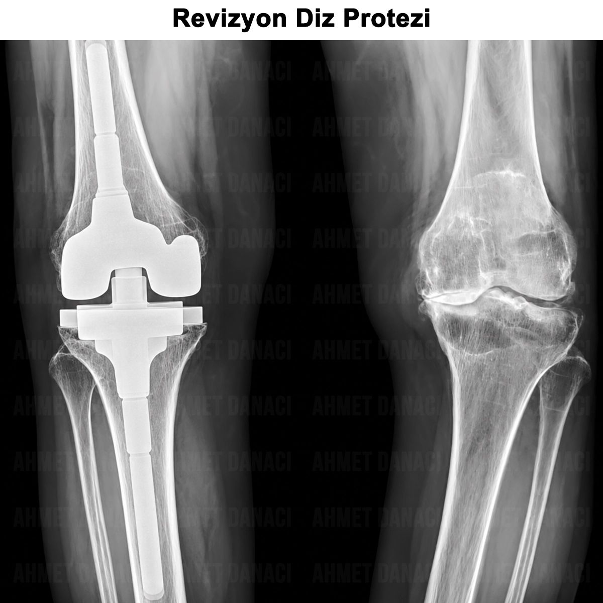Revizyon Diz Protezi: Nedir? Neden ve Nasıl Yapılır?