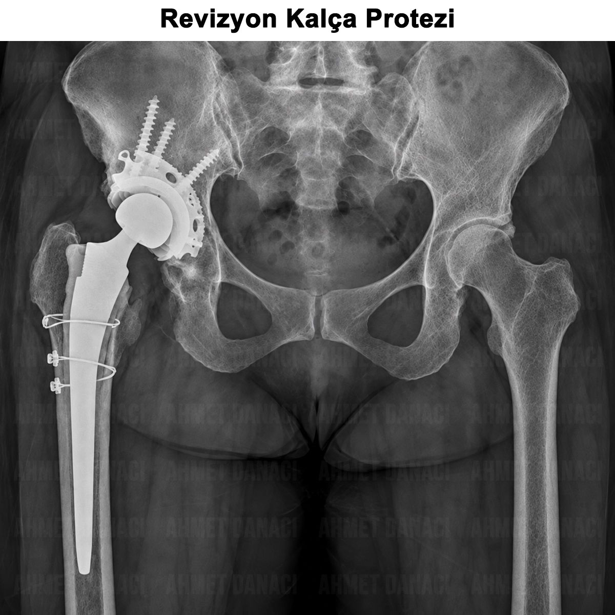 Revizyon Kalça Protezi: Nedir? Neden ve Nasıl Yapılır?