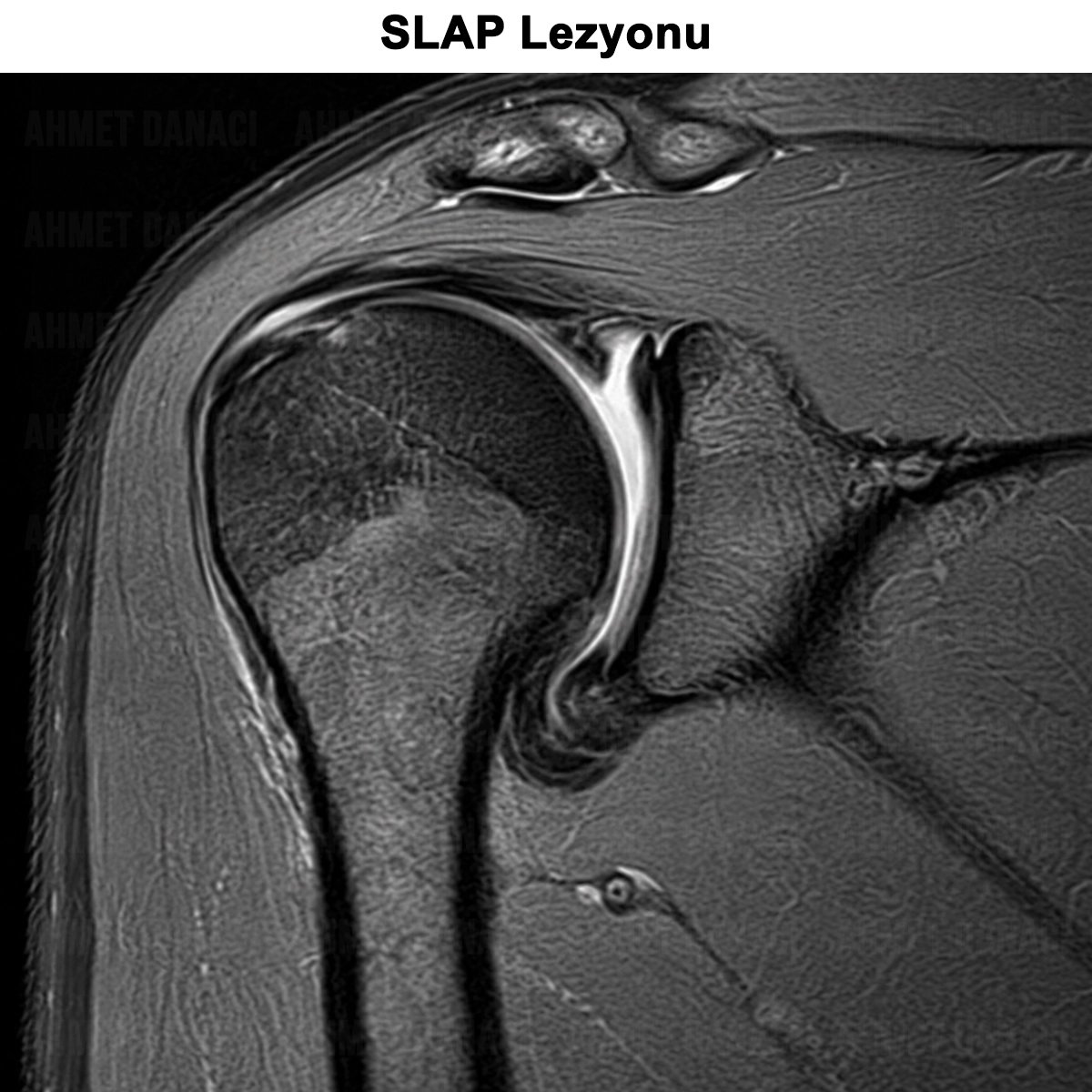 SLAP Lezyonu: Nedir? Neden Olur? Tanısı ve Tedavisi