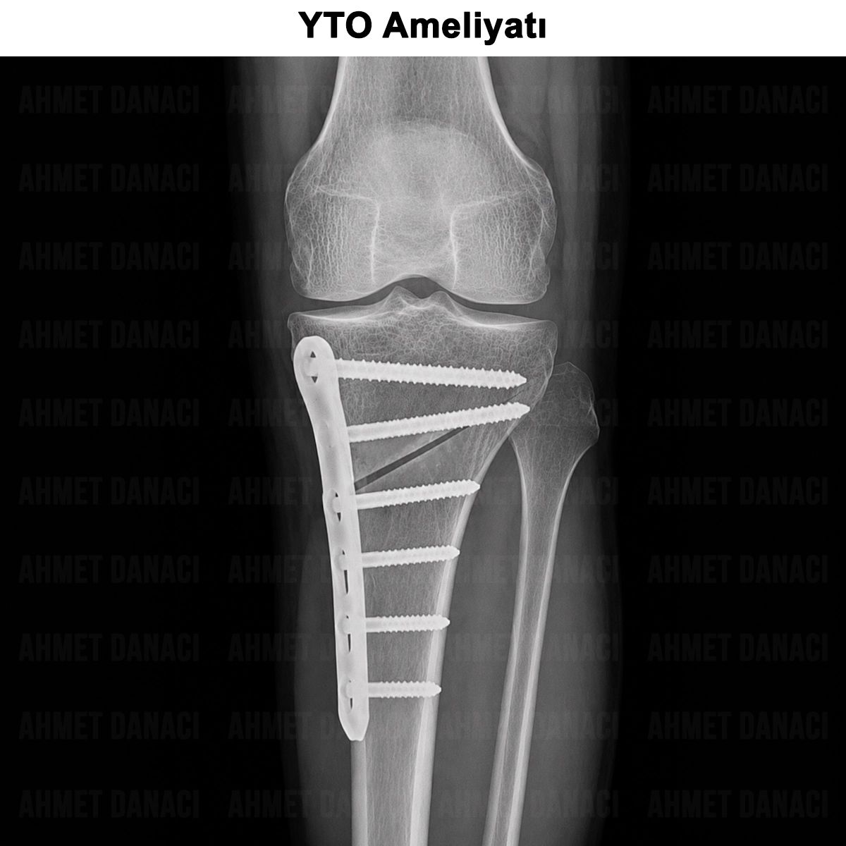 Yüksek Tibial Osteotomi (YTO): Nedir? Kimlere Yapılır?